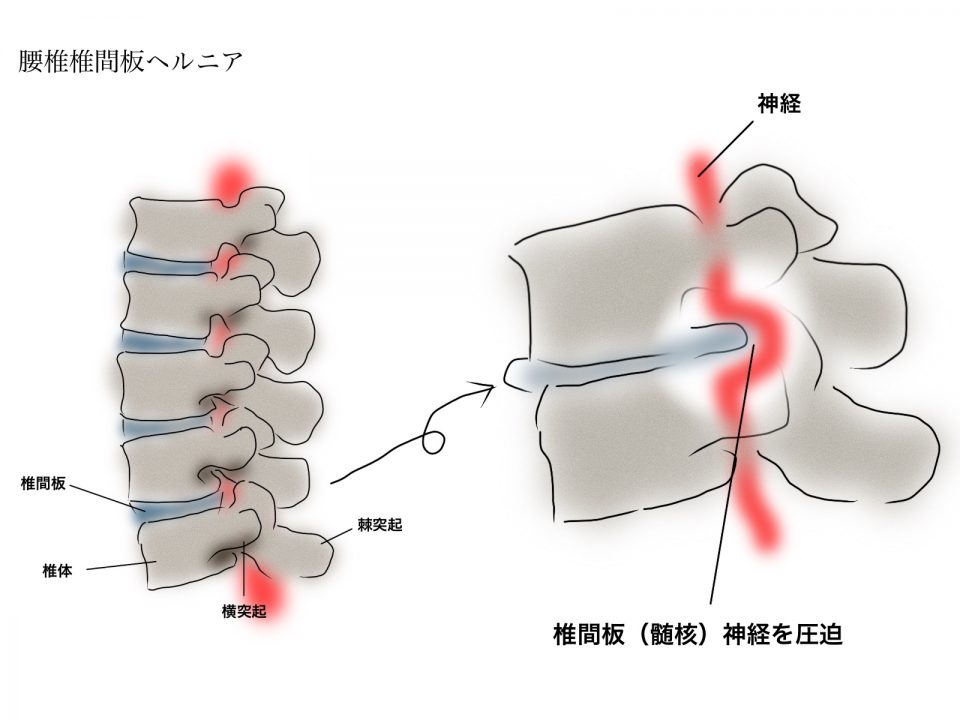 椎間板ヘルニアのイラスト