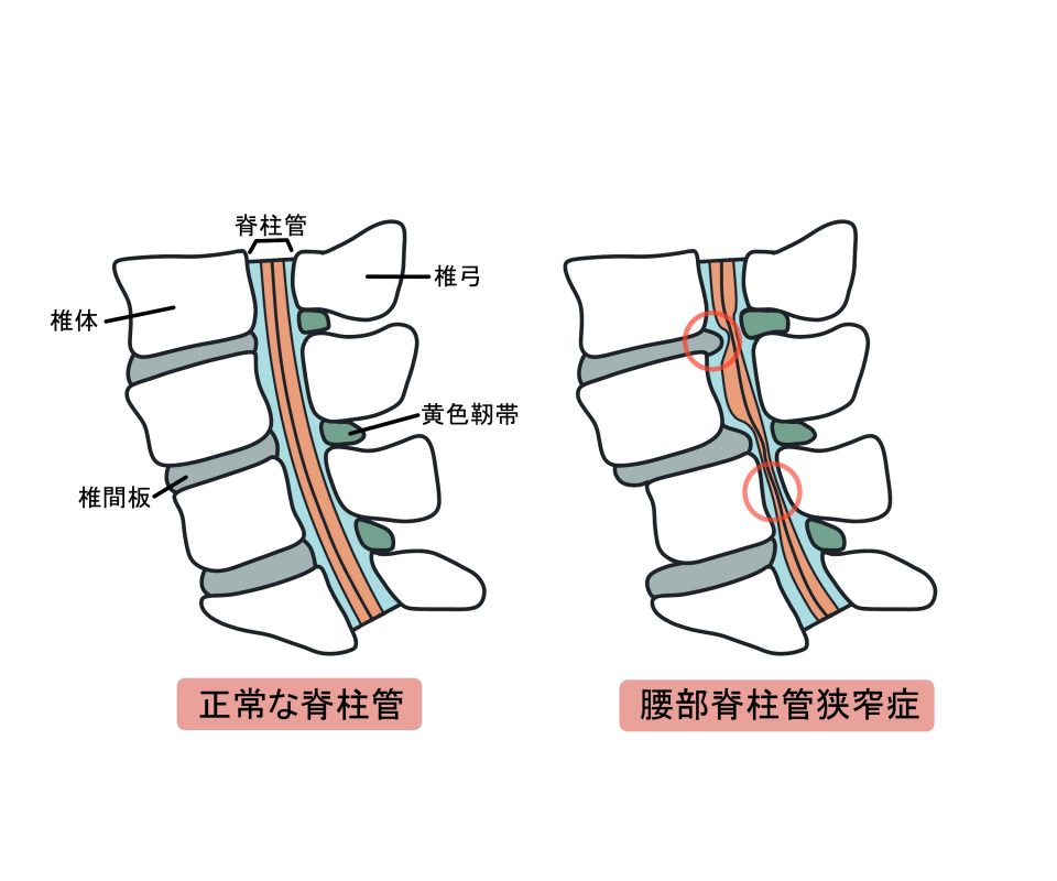 脊柱管狭窄症のイラスト