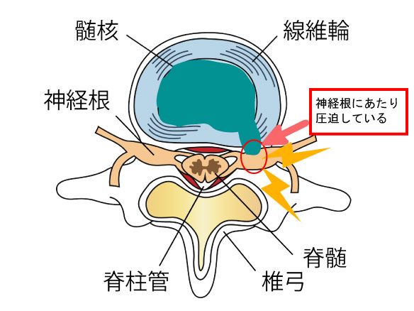 ヘルニアの原因