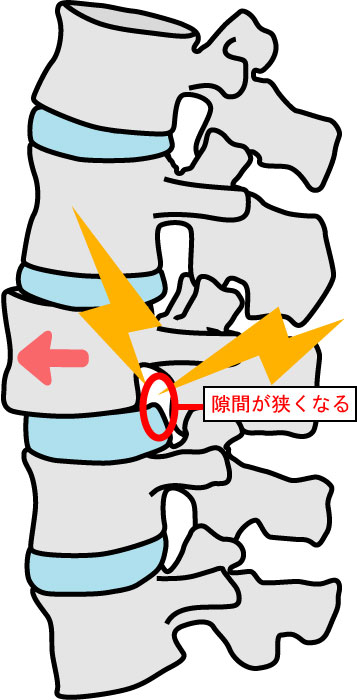 狭窄している腰椎