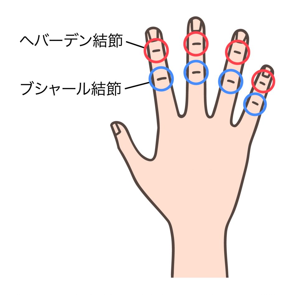 ヘパーデンとブシャールの違いのイラスト