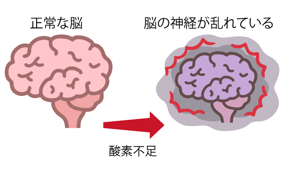 正常と異常な脳の比較のイラスト